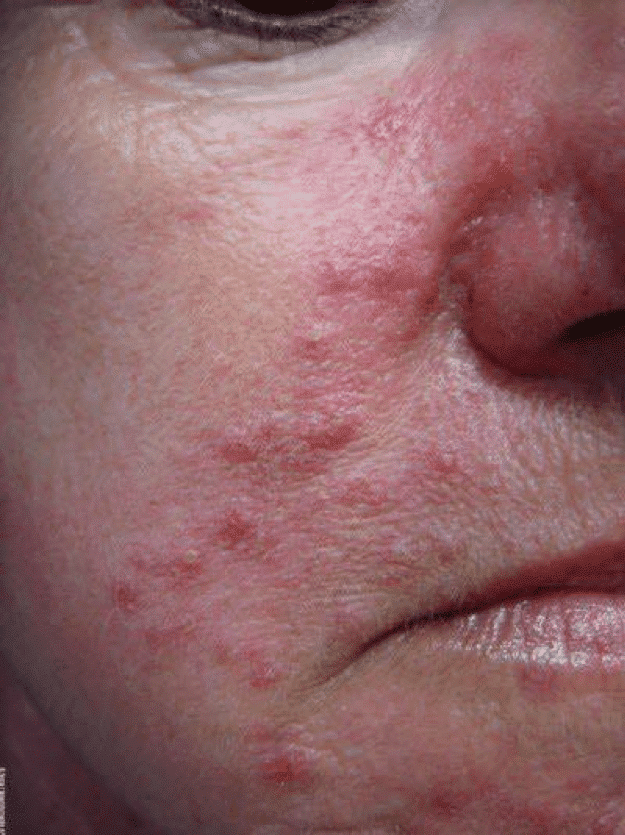 rosacea