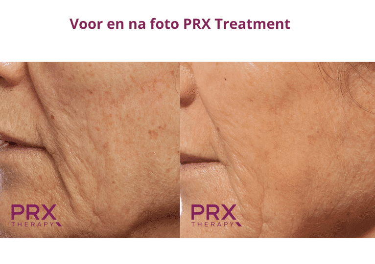 PRX T33 behandeling