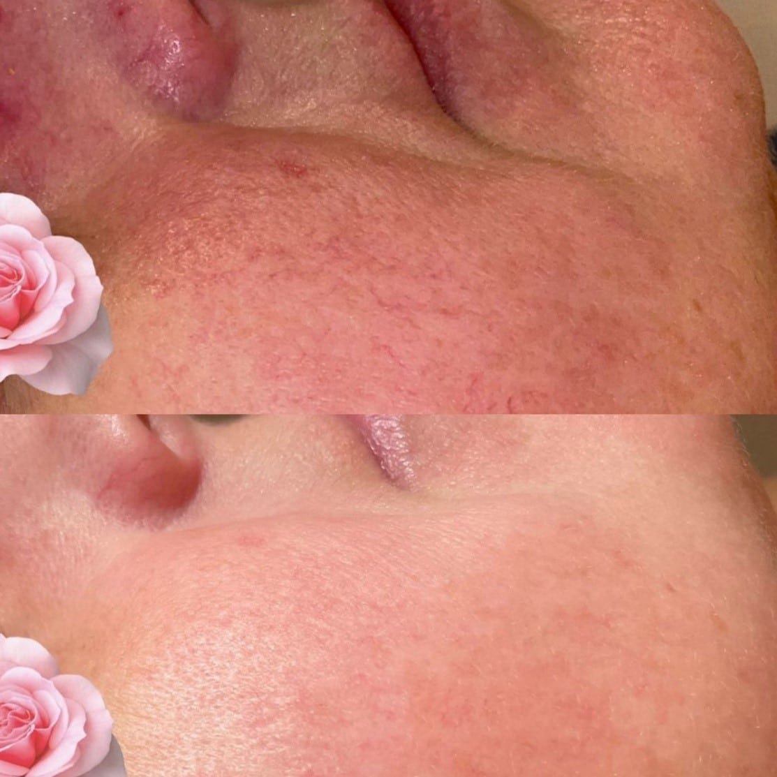 heb je last van rosacea?