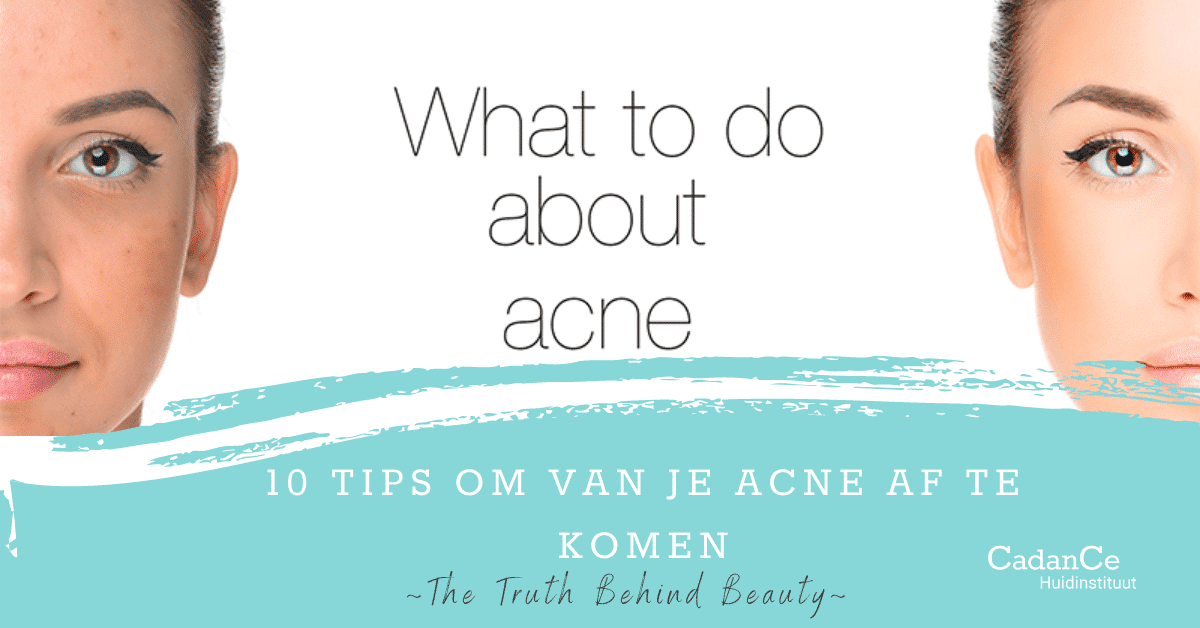 Blog-10-tips-om-van-je-acne-af-te-komen