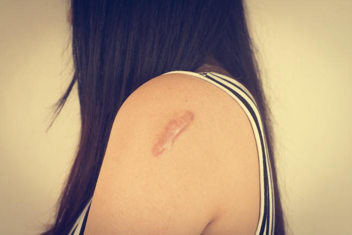 littekenbehandeling bij CadanCe Huidinstituut