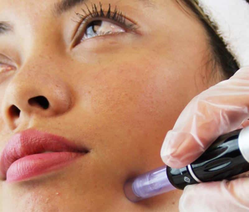 microneedling voor het gezicht